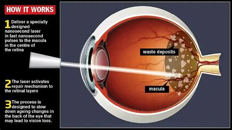 The placebo group got a similar treatment of 100-fold lower intensity. . Infrared light therapy for macular degeneration